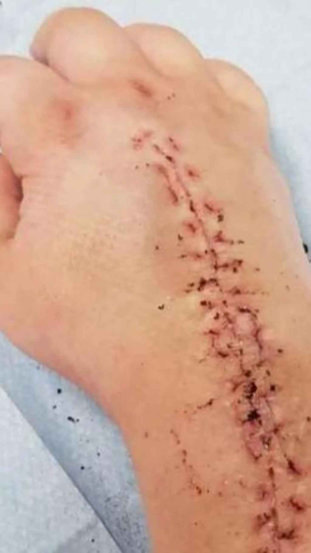 Georgia's wrist, which appears to have been recently operated on. It appears to be resting on a hospital bed. It shows a large scar and evidence of stitches and dried blood.