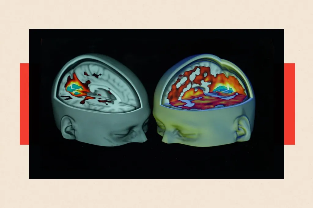 A picture of a brain scan of a person who has not taken psychedelics next to the hyperactive brain of someone who has taken psychedelics