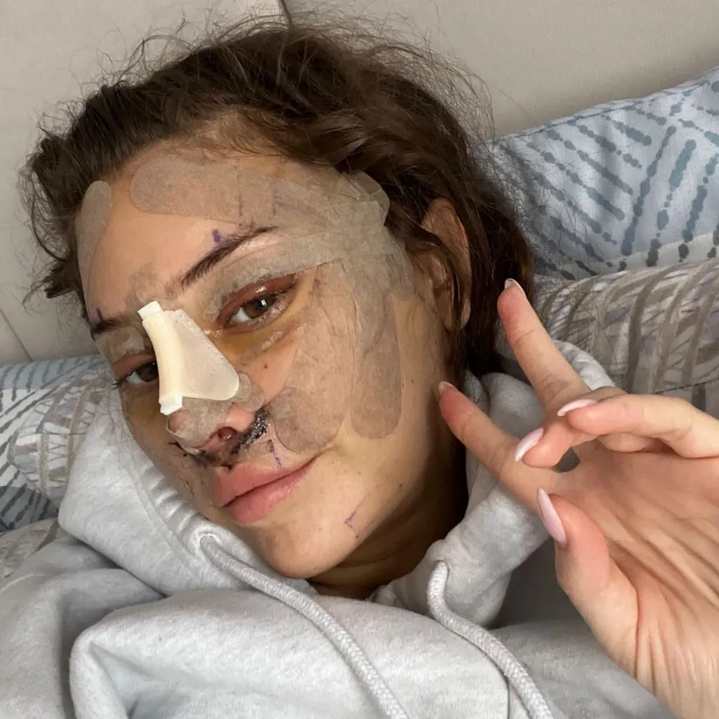 Emily post surgery. She has plasters across her brow and cheeks as well as on her nose. She is holding up two fingers to the camera in a v sign as she lays on a bed