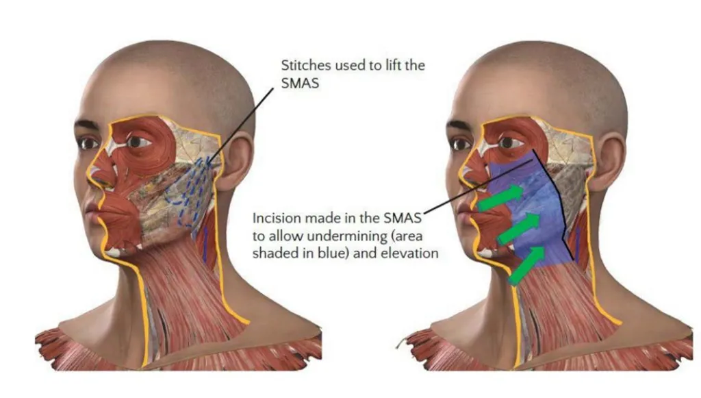 A diagram showing how a facelift is carried out. There are two images of a face and neck with cross sections showing under the skin

This diagram shows how surgeons cut under several layers before reaching the deep plane which they reshape