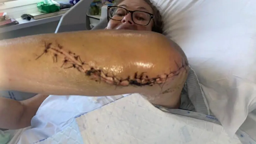 A woman is lying in a hospital bed - she is wearing glasses and holding up her elbow.  A huge, stitched up scar can be seen from the end of her elbow to half way along her arm.